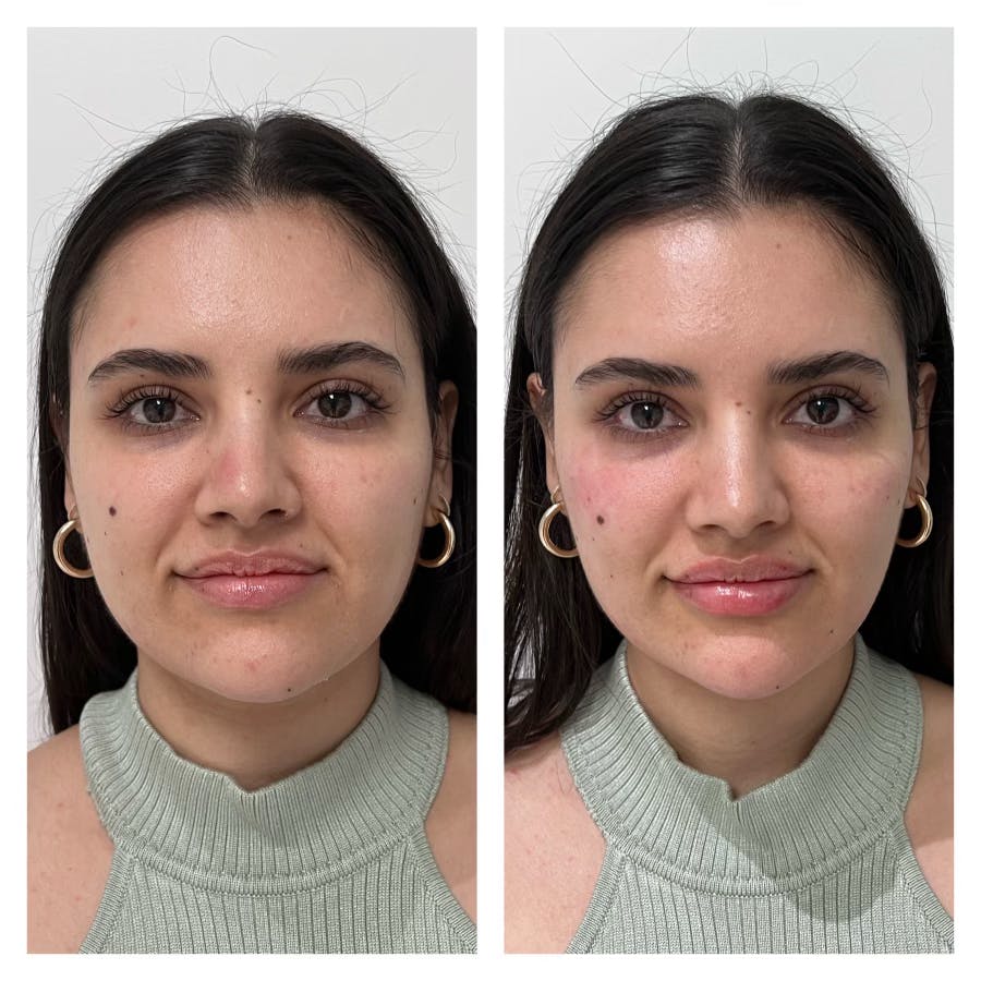 Dermal Fillers Before & After Gallery - Patient 122582847 - Image 1