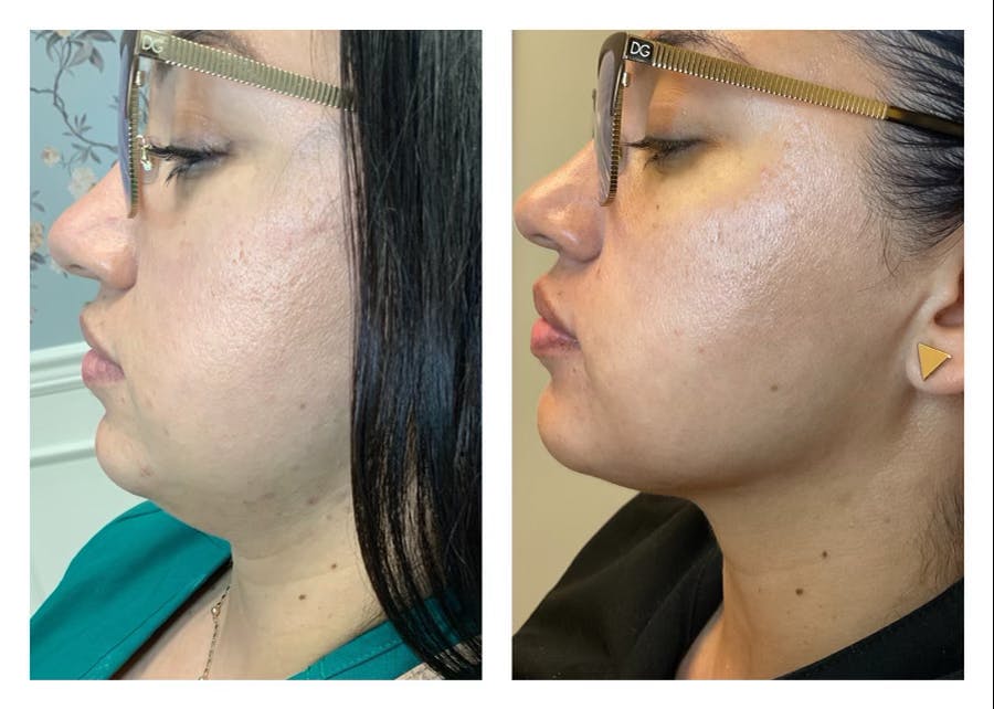 FAT BOMB (Face) Before & After Gallery - Patient 122582851 - Image 2