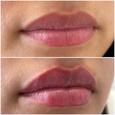Petite Pout® Before & After Gallery - Patient 122582854 - Image 1