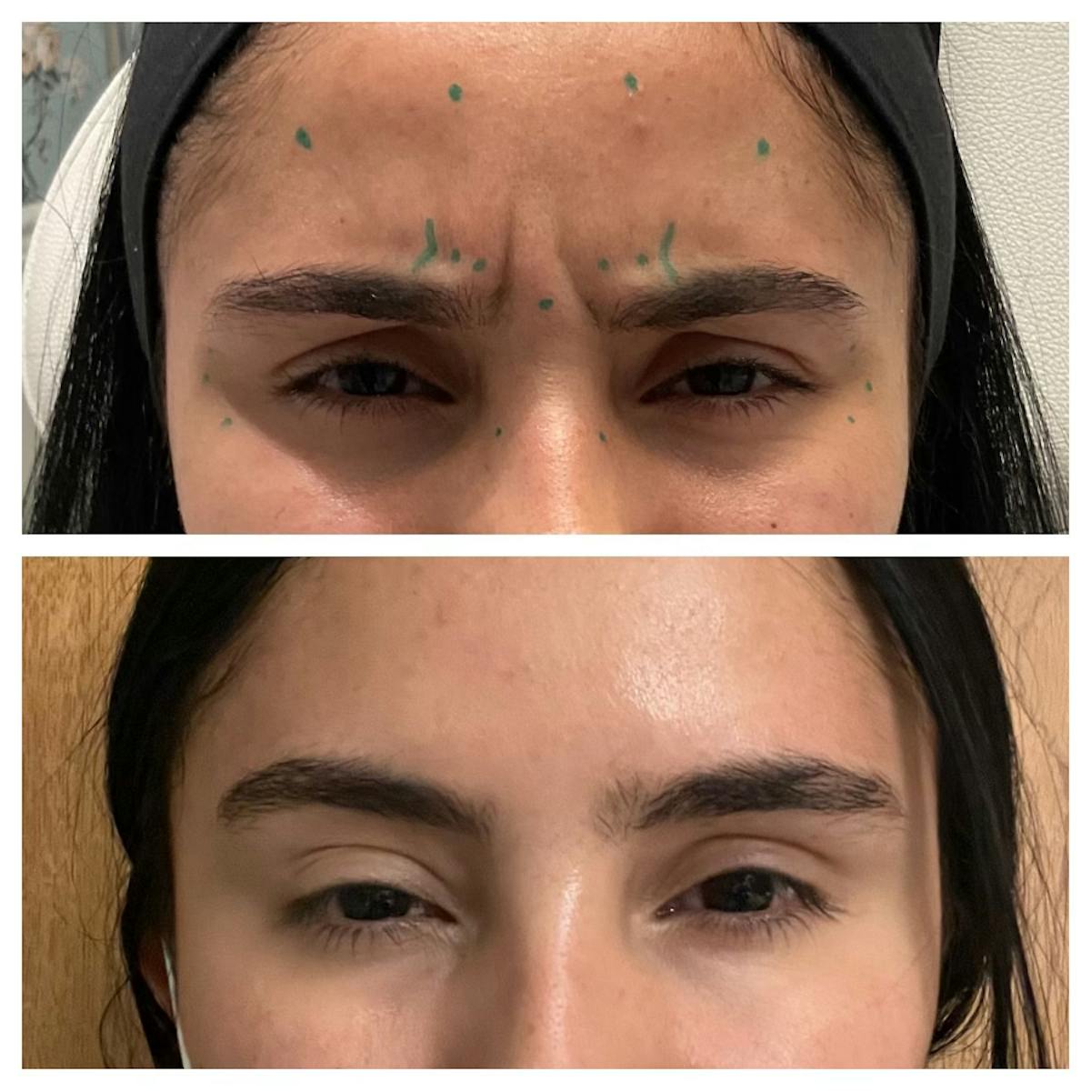 Wrinkle Relaxers Before & After Gallery - Patient 122582855 - Image 1