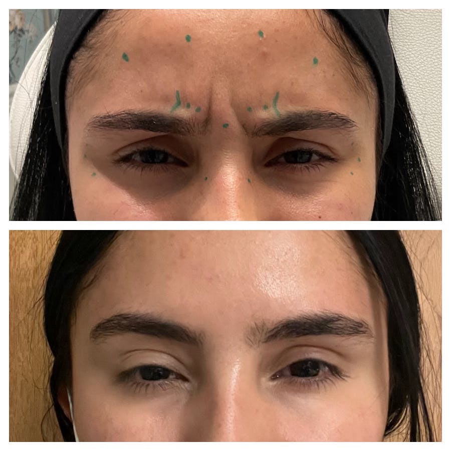 Wrinkle Relaxers Before & After Gallery - Patient 122582855 - Image 1