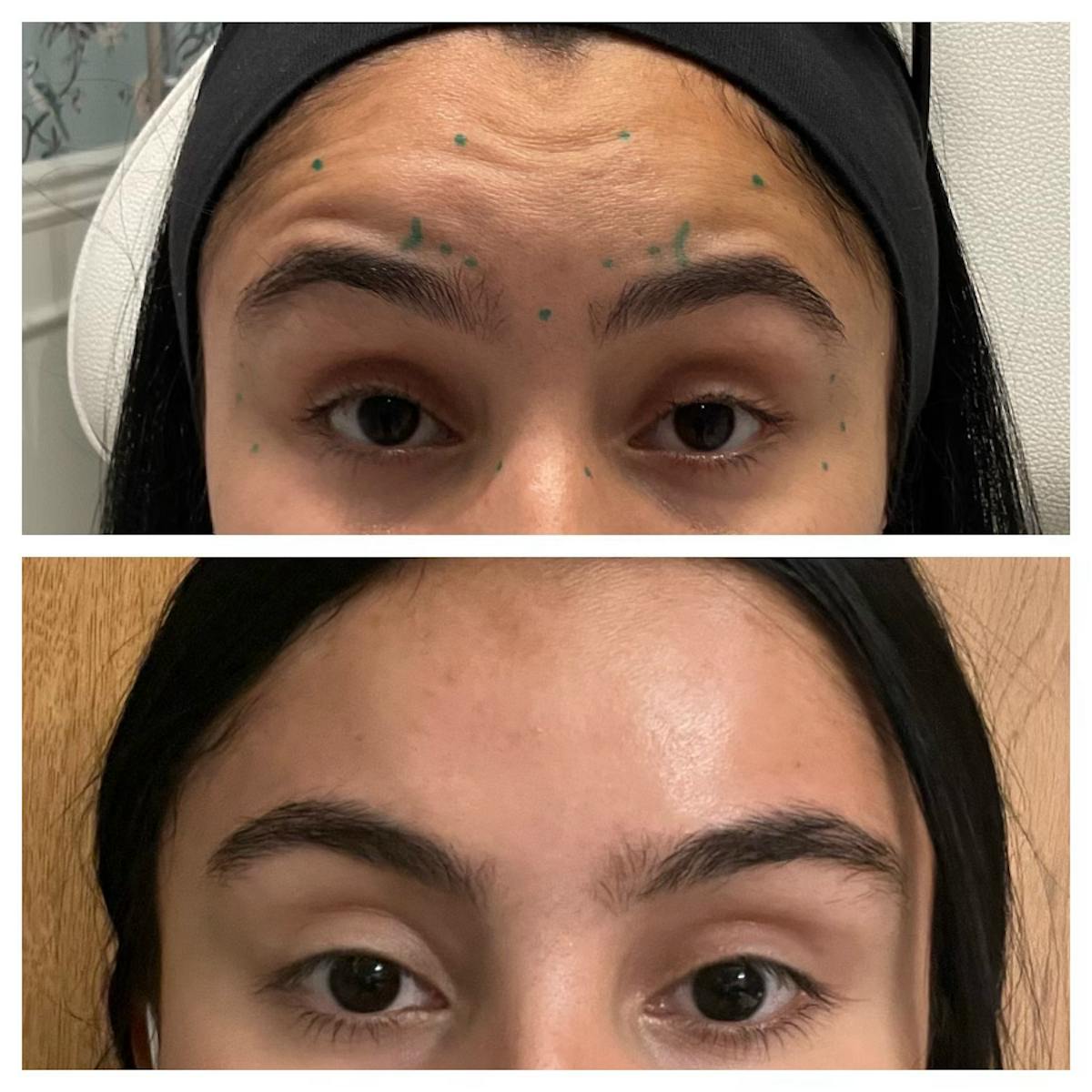 Wrinkle Relaxers Before & After Gallery - Patient 122582855 - Image 2