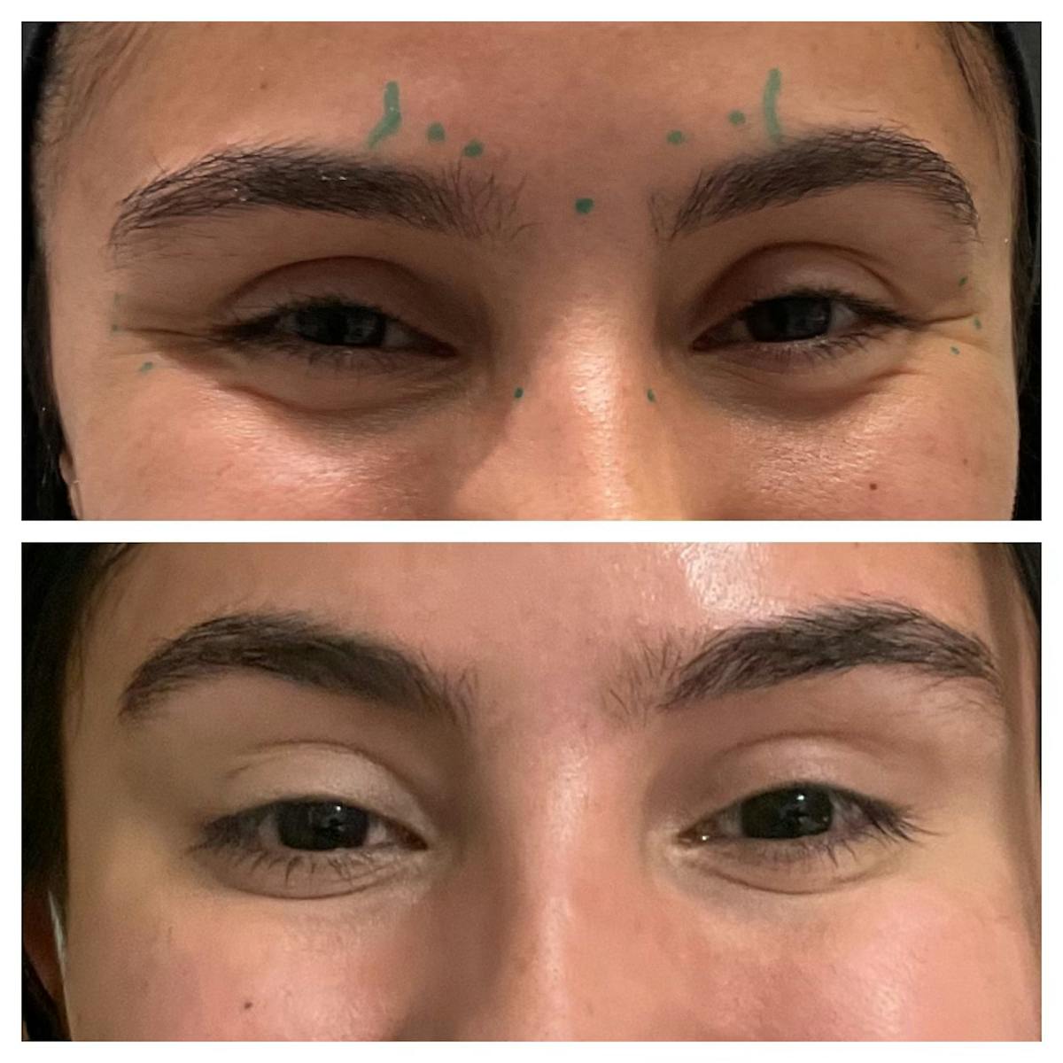 Wrinkle Relaxers Before & After Gallery - Patient 122582855 - Image 3