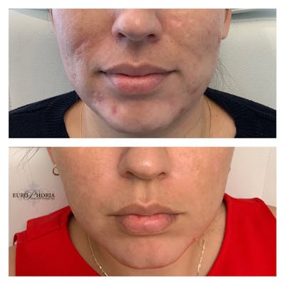 Vampire Facelift® Before & After Gallery - Patient 122727340 - Image 1