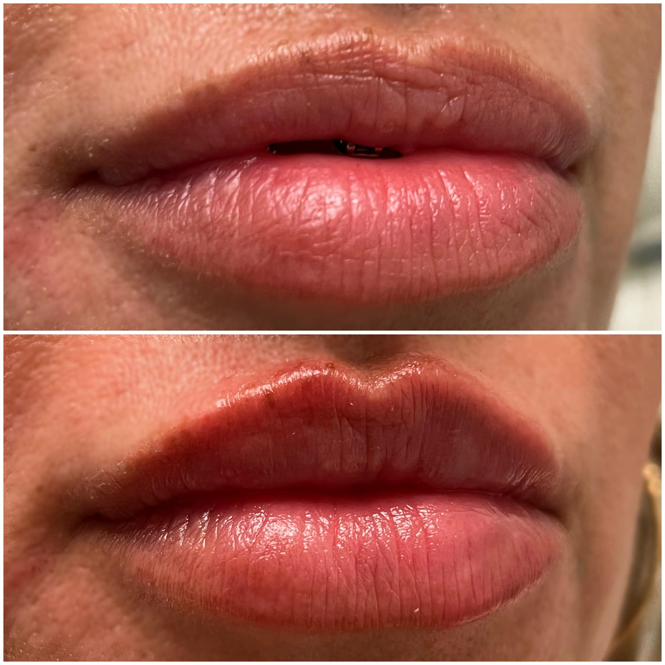 Petite Pout® Before & After Gallery - Patient 122727347 - Image 1