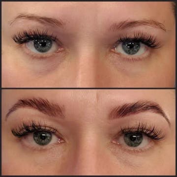 Brow Treatments Before & After Gallery - Patient 122727358 - Image 1