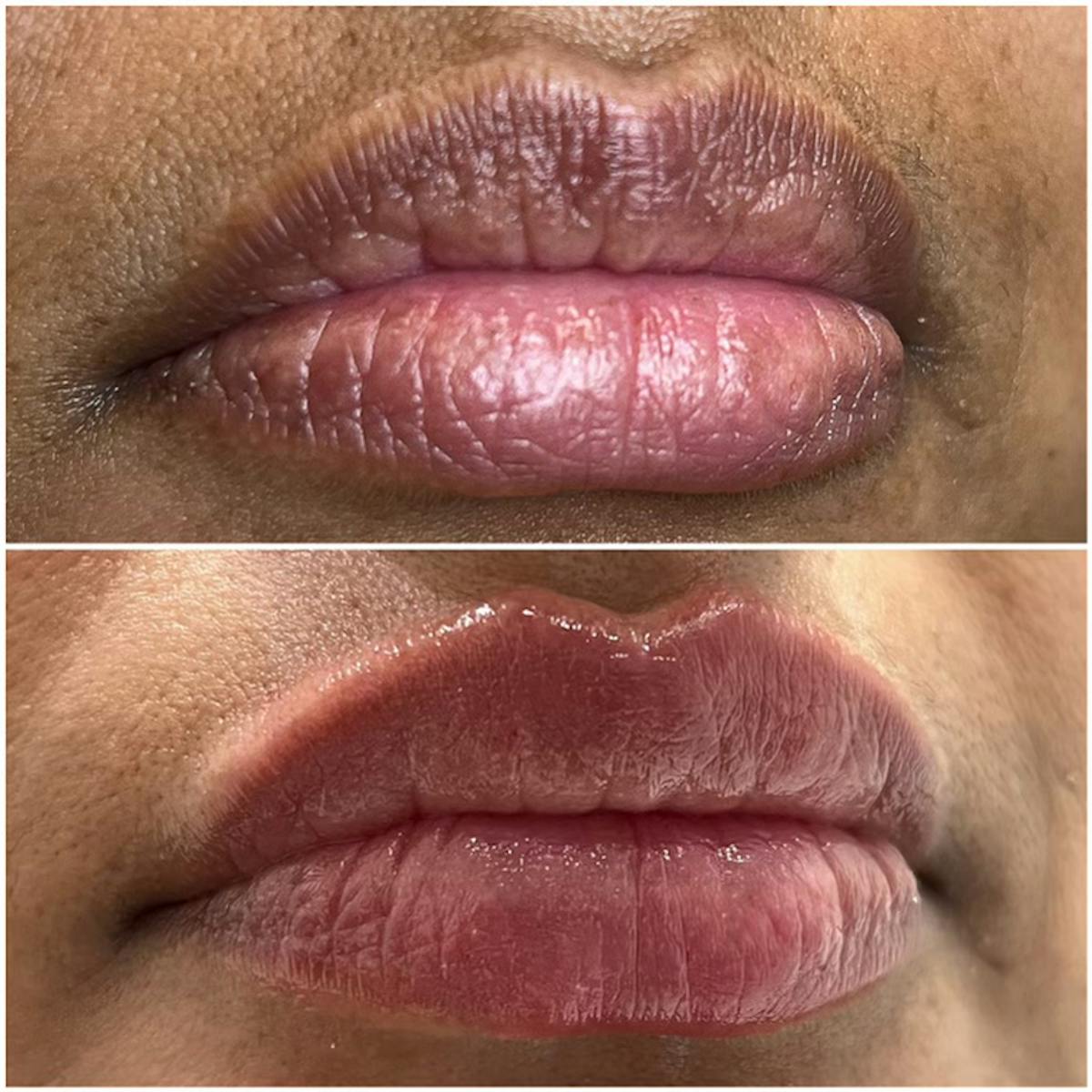 Petite Pout® Before & After Gallery - Patient 122889727 - Image 1