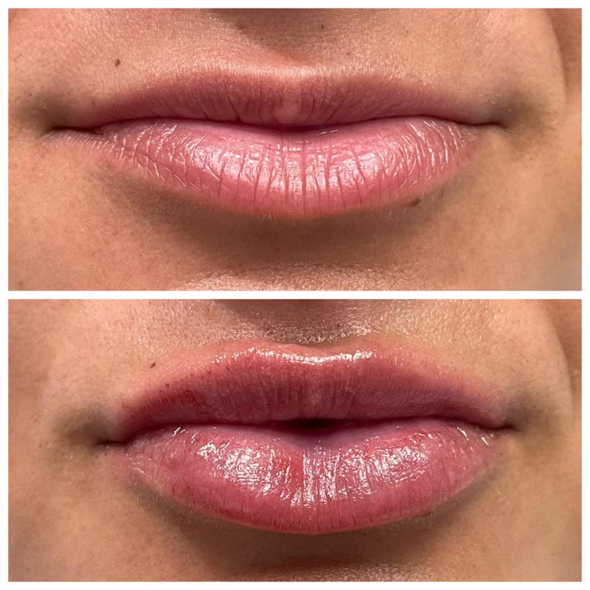Full Pout® Before & After Gallery - Patient 141086963 - Image 1