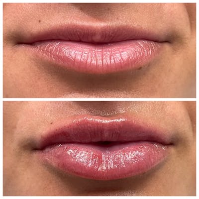 Full Pout® Before & After Gallery - Patient 141086963 - Image 1