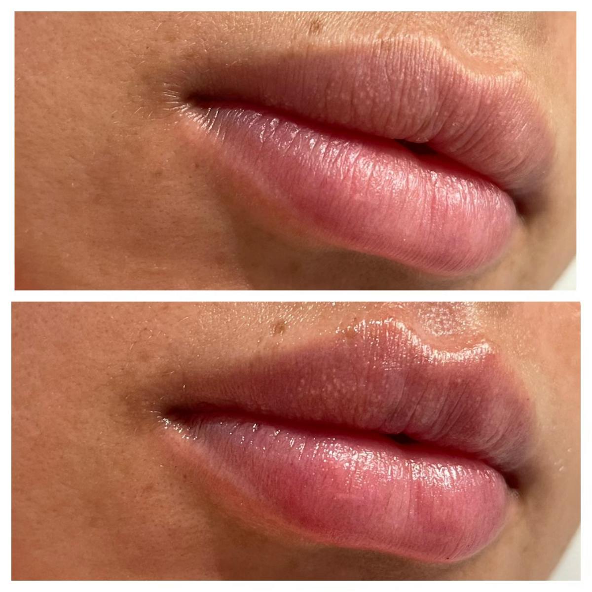 Full Pout® Before & After Gallery - Patient 141201293 - Image 1
