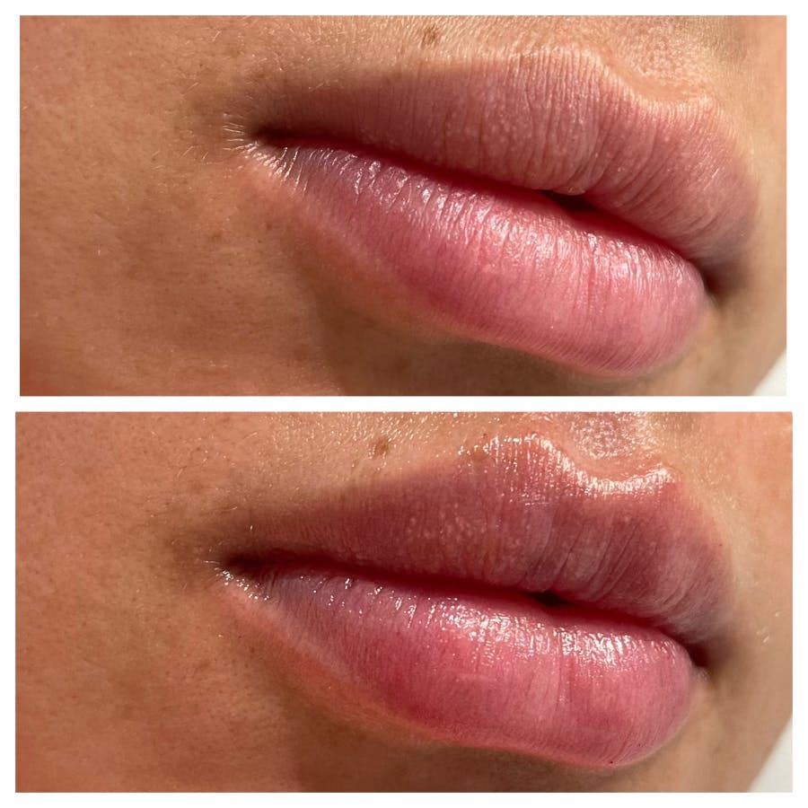 Full Pout® Before & After Gallery - Patient 141201293 - Image 1