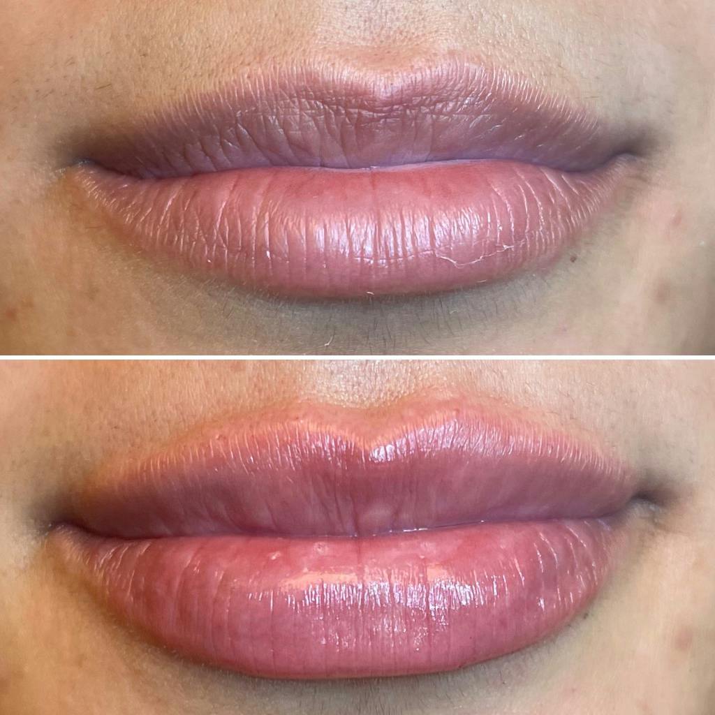 Full Pout® Before & After Gallery - Patient 141086962 - Image 1