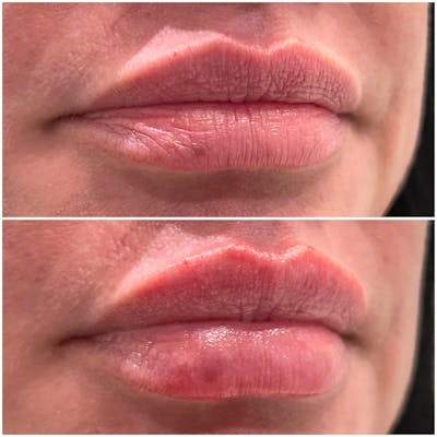 Full Pout® Before & After Gallery - Patient 141086964 - Image 1