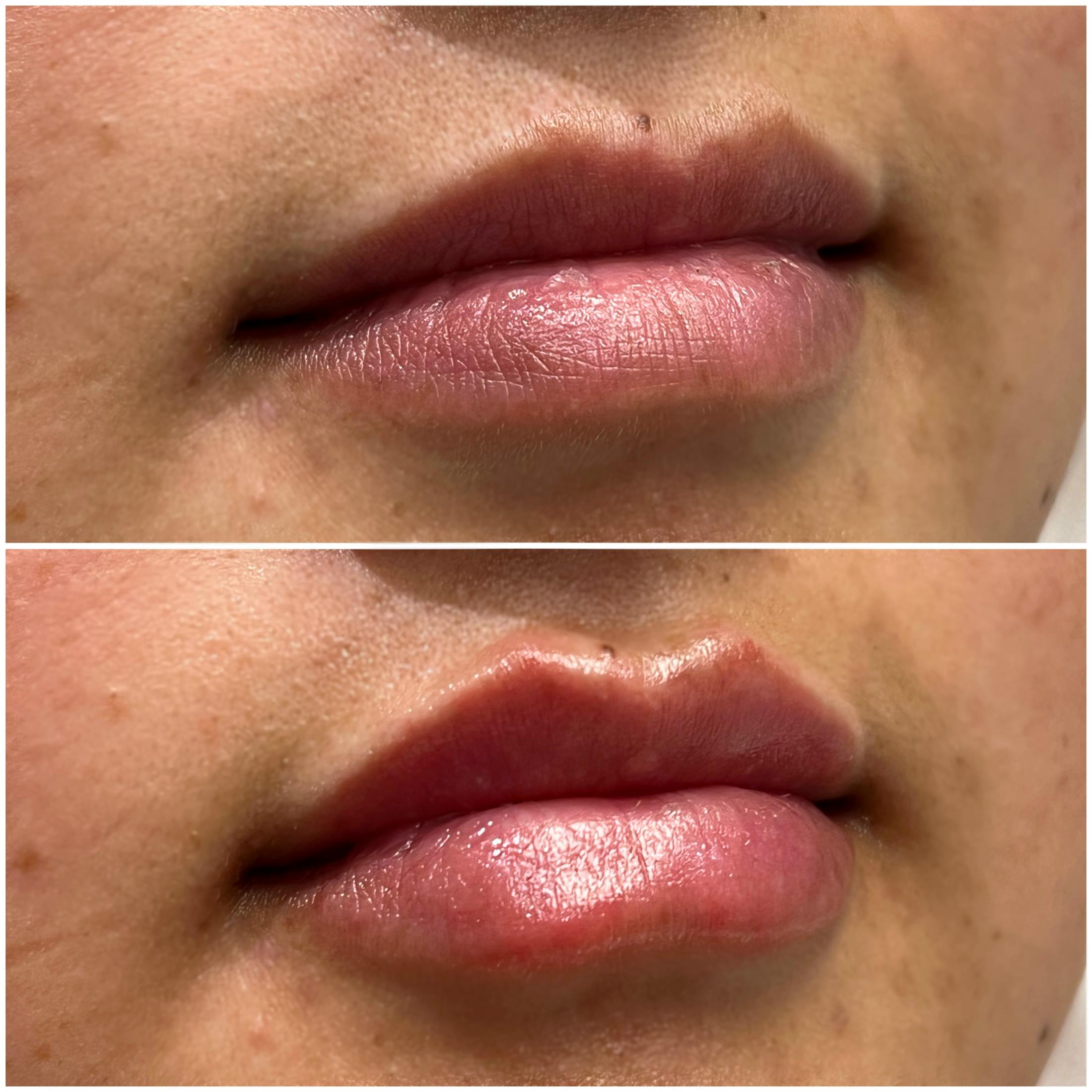 Full Pout® Before & After Gallery - Patient 141086966 - Image 1