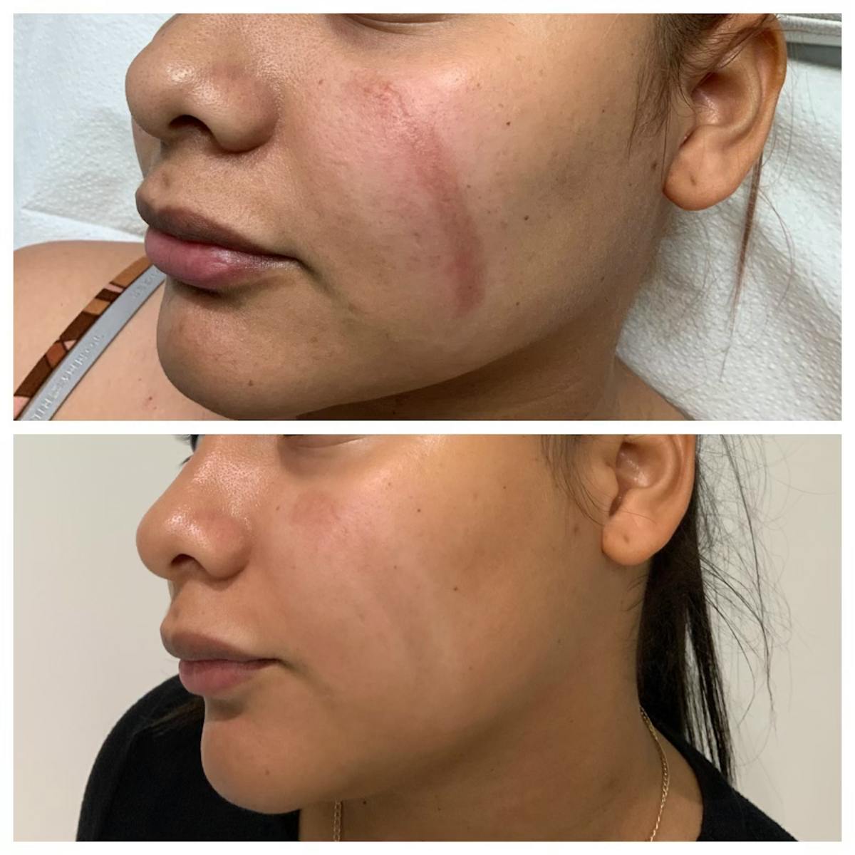 Fraxel Laser Before & After Gallery - Patient 141086968 - Image 1