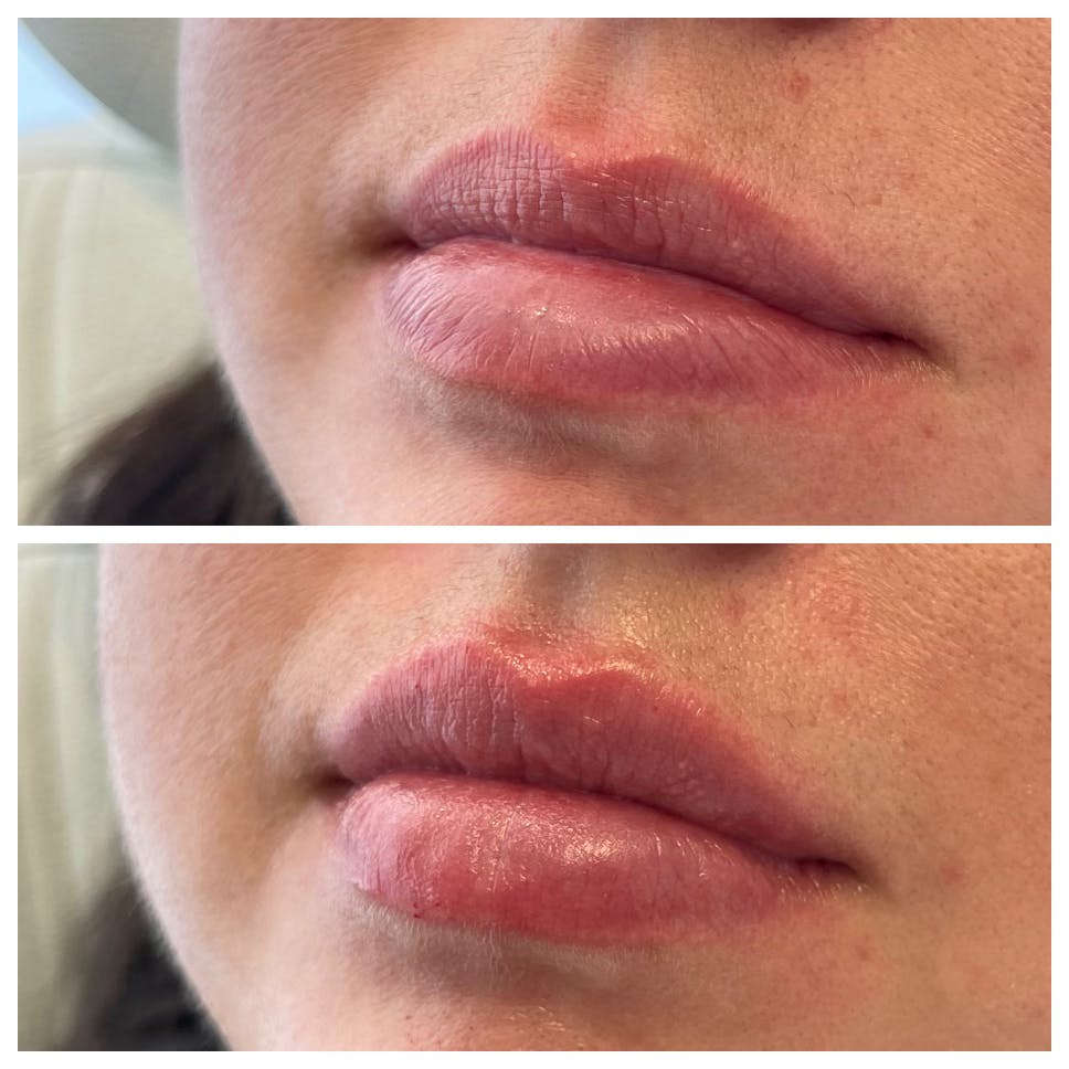Petite Pout® Before & After Gallery - Patient 141086972 - Image 1