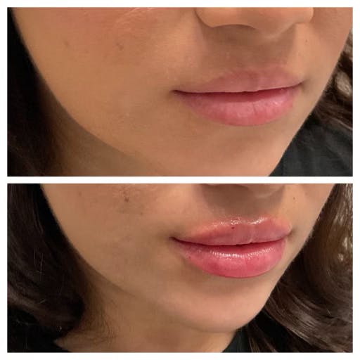 Petite Pout® Before & After Gallery - Patient 141086971 - Image 1