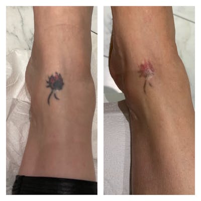 No RAGRETS Laser Tattoo Removal™ Gallery - Patient 141086983 - Image 1