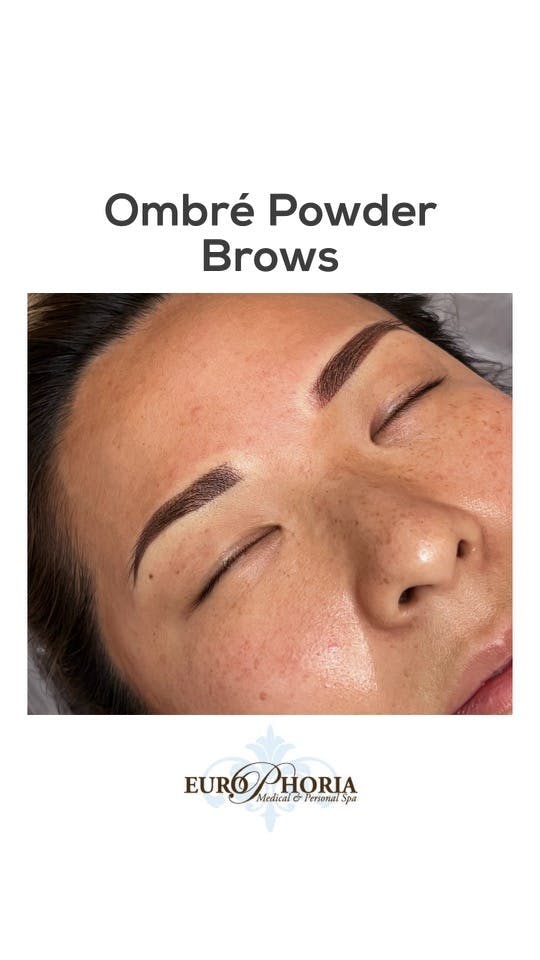 Brow Treatments Before & After Gallery - Patient 141201306 - Image 1