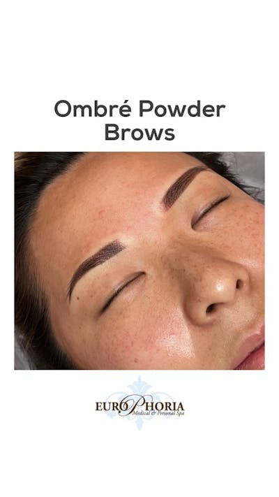 Brow Treatments Before & After Gallery - Patient 141201306 - Image 1