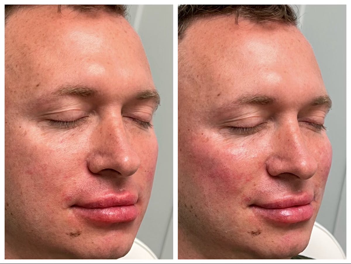 Dermal Fillers Before & After Gallery - Patient 141440689 - Image 1
