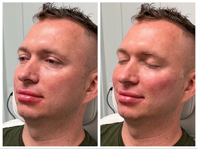 Dermal Fillers Before & After Gallery - Patient 141440688 - Image 1