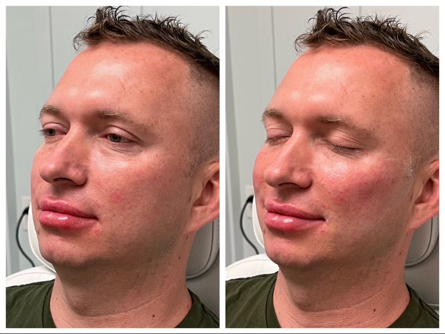 Dermal Fillers Before & After Gallery - Patient 141440688 - Image 1