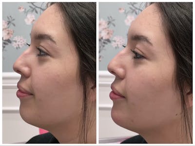 Dermal Fillers Before & After Gallery - Patient 141440690 - Image 1