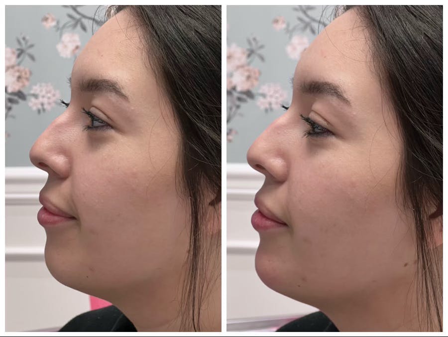 Dermal Fillers Before & After Gallery - Patient 141440690 - Image 1
