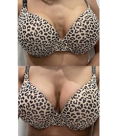 Vampire Breast Lift® Before & After Gallery - Patient 142703906 - Image 1