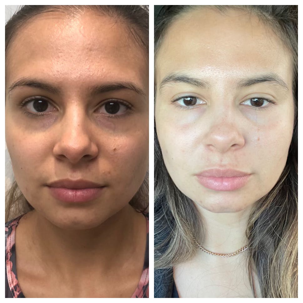 PRP Under Eyes Before & After Gallery - Patient 142706586 - Image 1