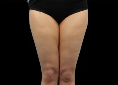  EMTONE® Before & After Gallery - Patient 144946779 - Image 1