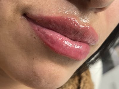 Petite Pout® Before & After Gallery - Patient 145033958 - Image 1