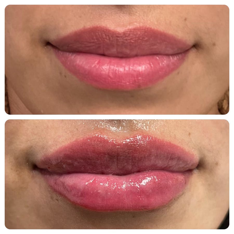 Petite Pout® Before & After Gallery - Patient 145033958 - Image 2