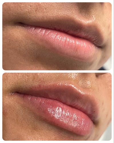 Full Pout® Before & After Gallery - Patient 145033969 - Image 1