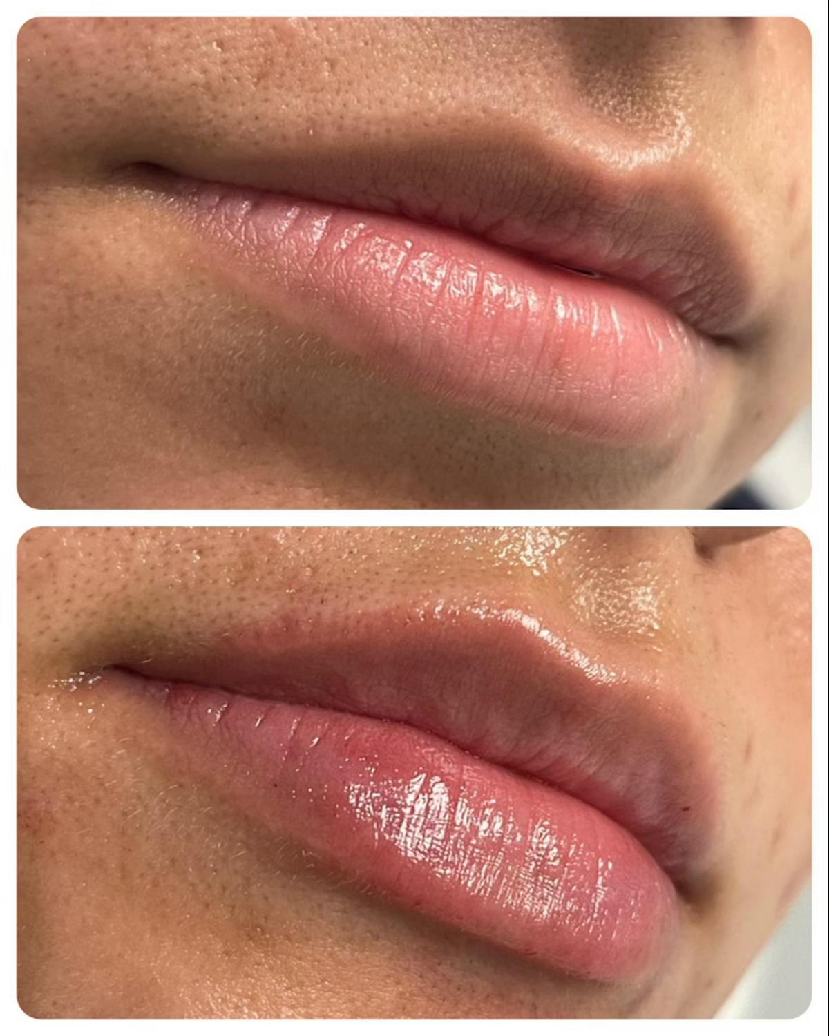 Full Pout® Before & After Gallery - Patient 145033969 - Image 1