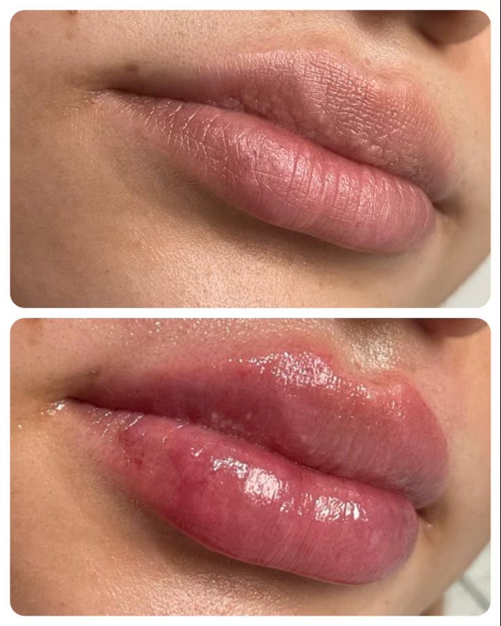Full Pout® Before & After Gallery - Patient 145033967 - Image 1