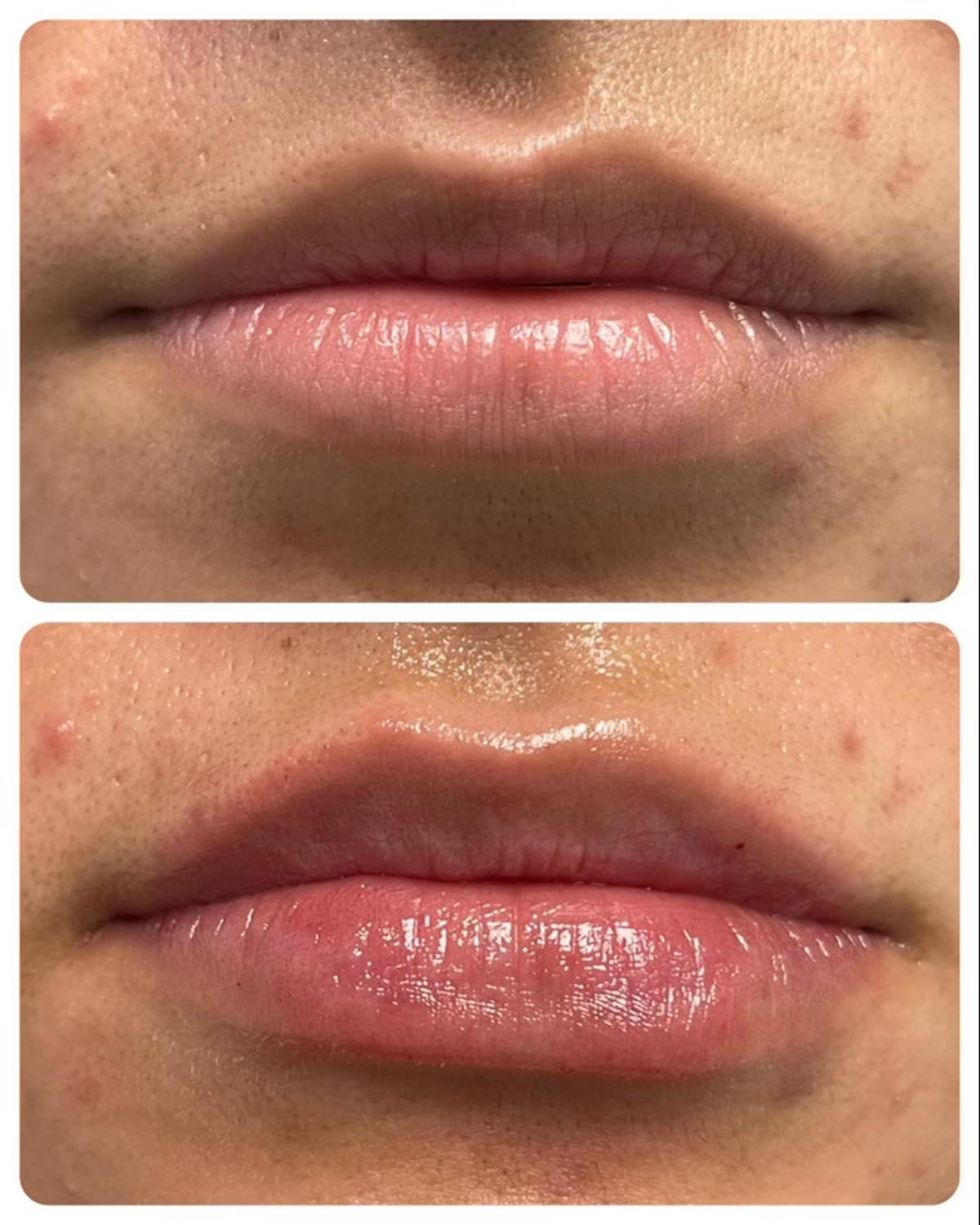 Full Pout® Before & After Gallery - Patient 145033968 - Image 1