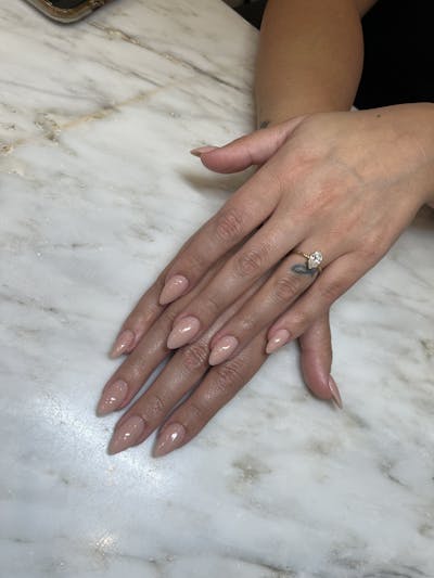 Signature Nail Treatments Before & After Gallery - Patient 145033995 - Image 1