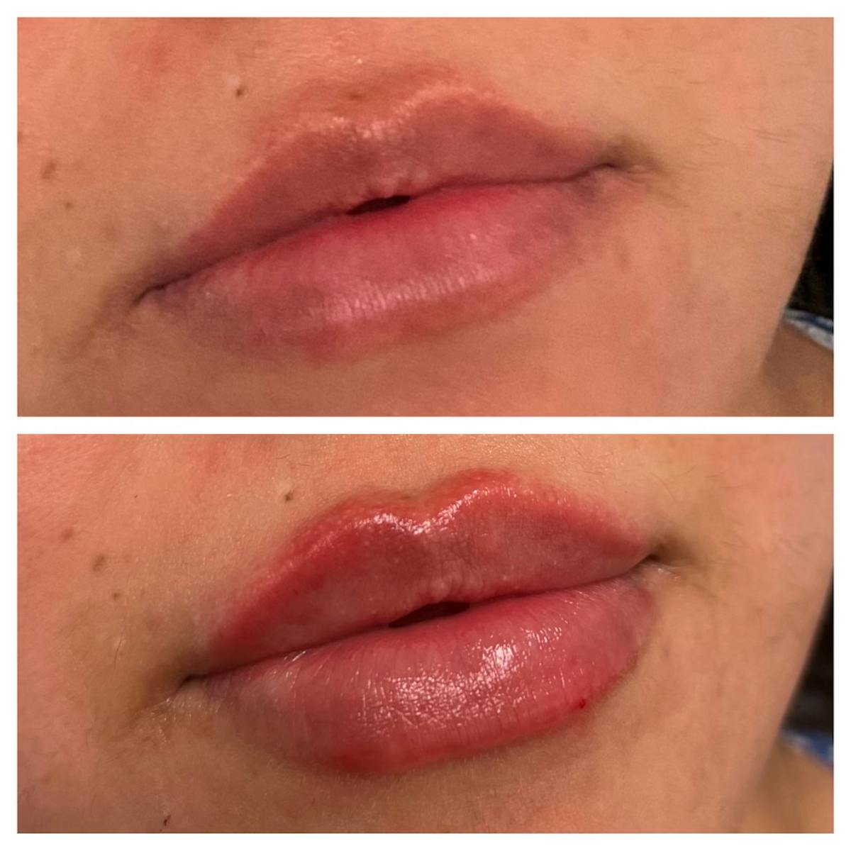 Petite Pout® Before & After Gallery - Patient 145033959 - Image 1