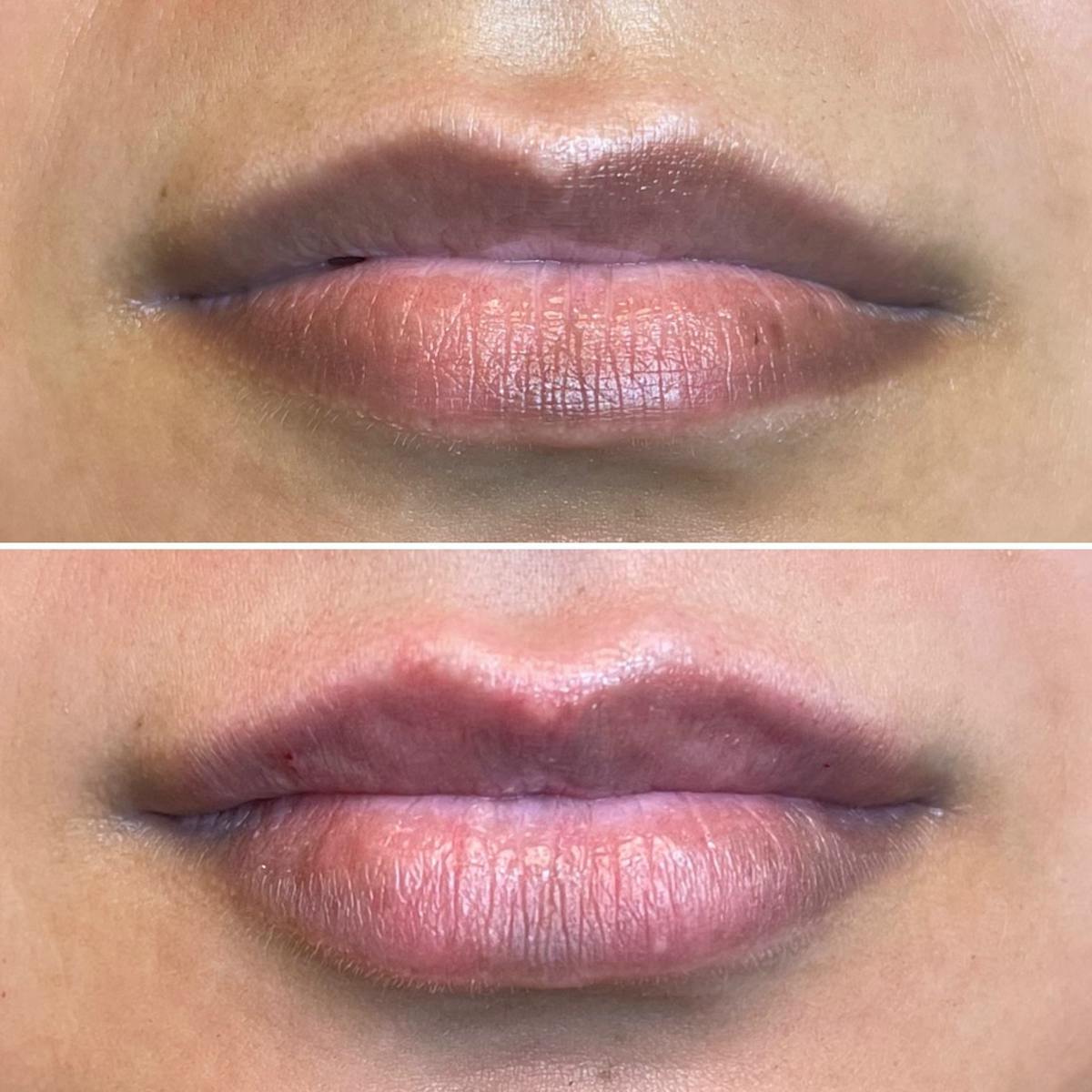 Petite Pout® Before & After Gallery - Patient 145034022 - Image 1