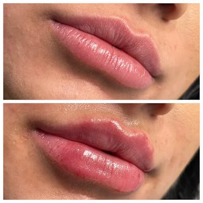 Full Pout® Before & After Gallery - Patient 145034024 - Image 1