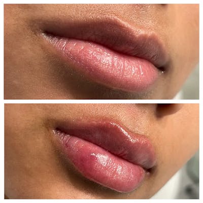 Petite Pout® Before & After Gallery - Patient 145034025 - Image 1
