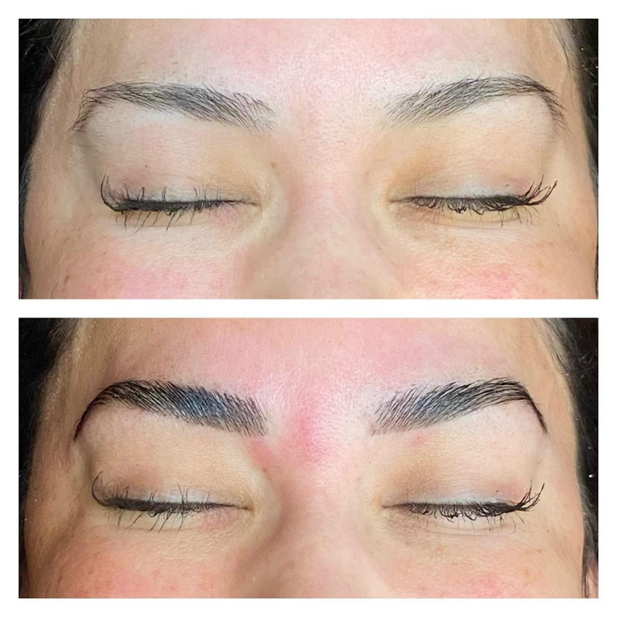 Brow Treatments Before & After Gallery - Patient 145034032 - Image 1