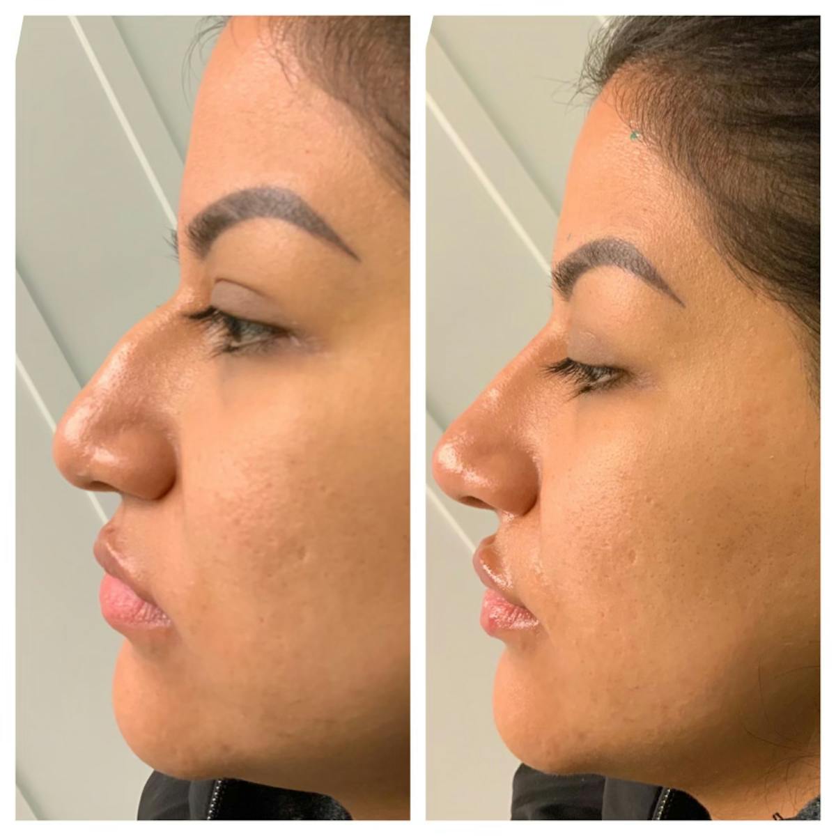 Non-Surgical Rhinoplasty Before & After Gallery - Patient 148023252 - Image 1