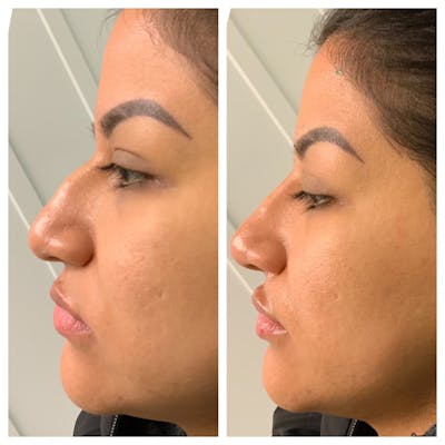 Non-Surgical Rhinoplasty Before & After Gallery - Patient 148023252 - Image 1