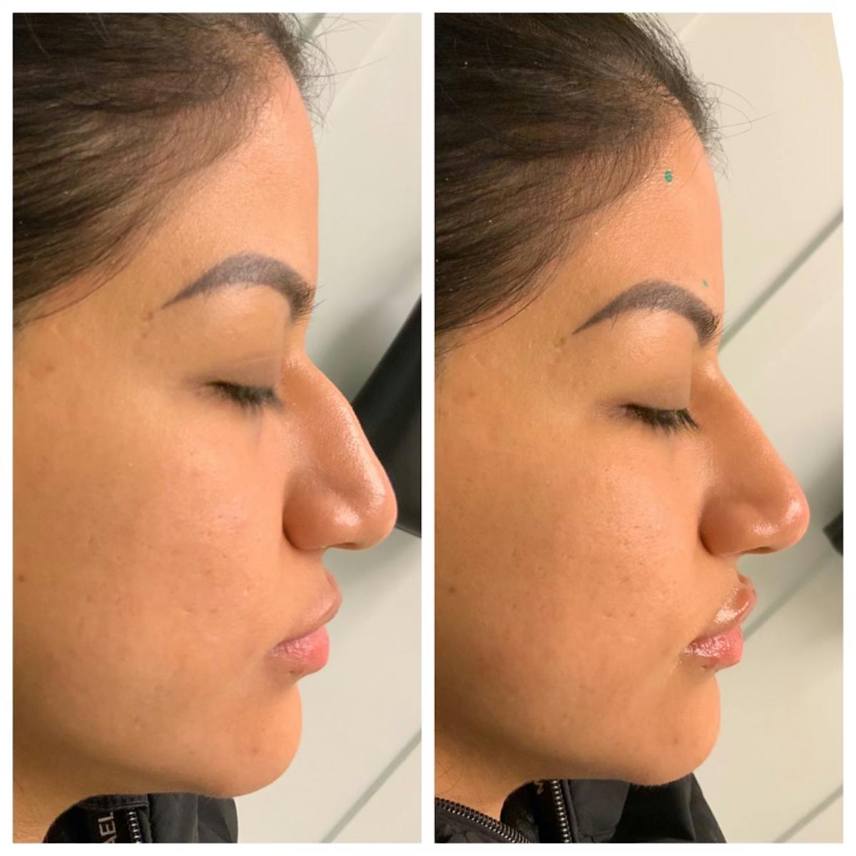 Non-Surgical Rhinoplasty Before & After Gallery - Patient 148023252 - Image 2