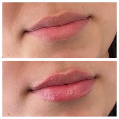 Petite Pout® Before & After Gallery - Patient 148023254 - Image 1