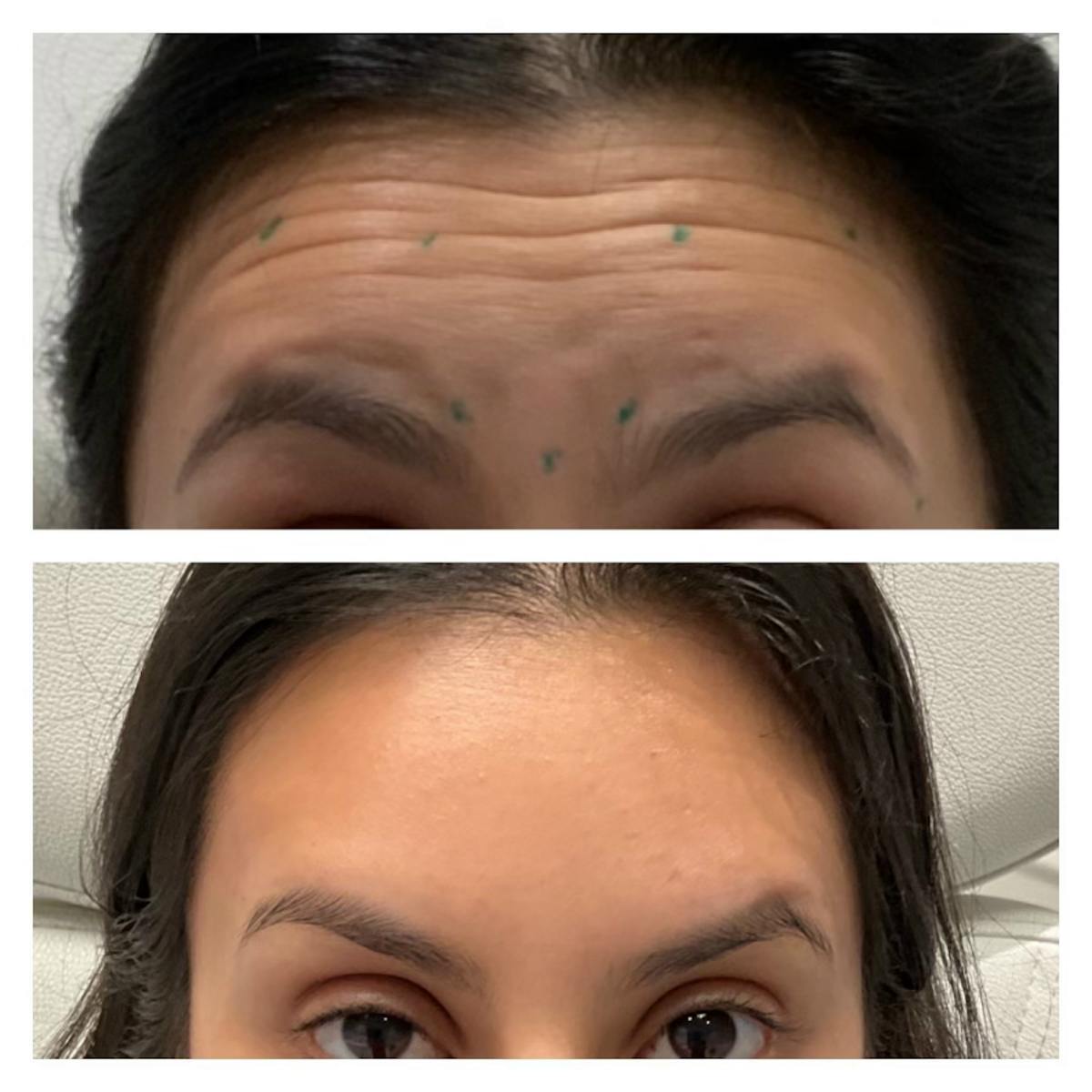 Wrinkle Relaxers Before & After Gallery - Patient 148023255 - Image 1