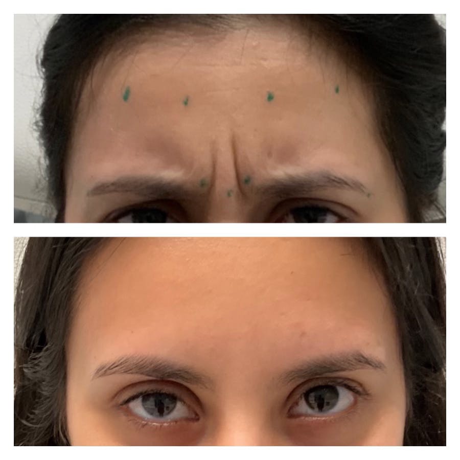 Wrinkle Relaxers Before & After Gallery - Patient 148023255 - Image 2